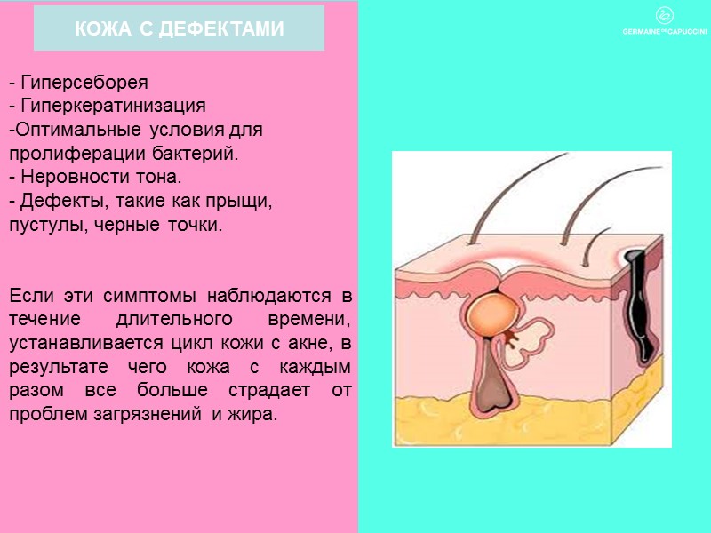 КОЖА С ДЕФЕКТАМИ - Гиперсеборея - Гиперкератинизация -Оптимальные условия для пролиферации бактерий. - Неровности